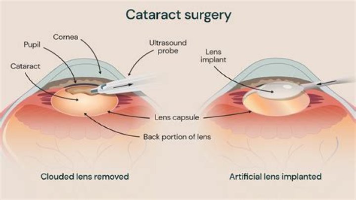 Are colors more vivid after cataract surgery?