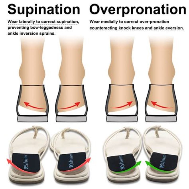Are flat feet overpronation or Underpronation?