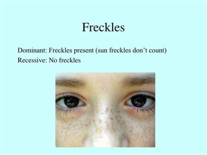 Are freckles dominant?