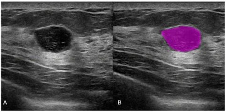 Can an ultrasound tell if a tumor is benign or malignant?