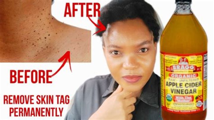 Can Apple cider vinegar remove keloids?