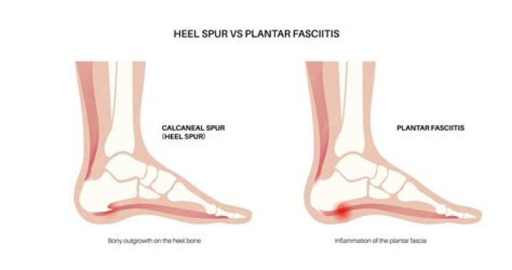Can cross country skiing cause plantar fasciitis?