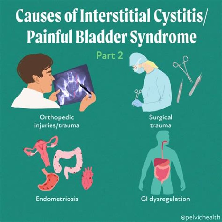 Can interstitial cystitis start suddenly?