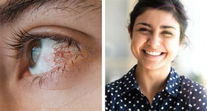 Can milk damage your eyes?
