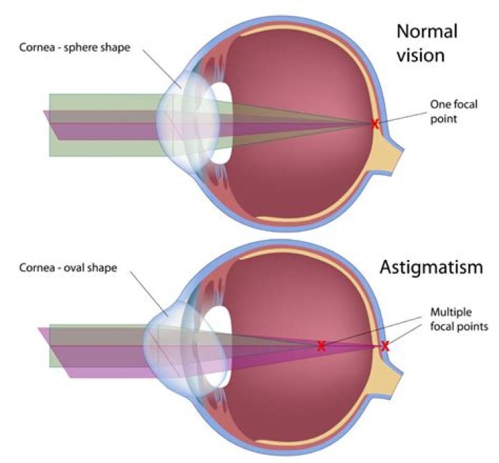 Can rubbing your eyes cause astigmatism?