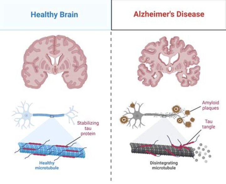 Can stress cause Alzheimer's?