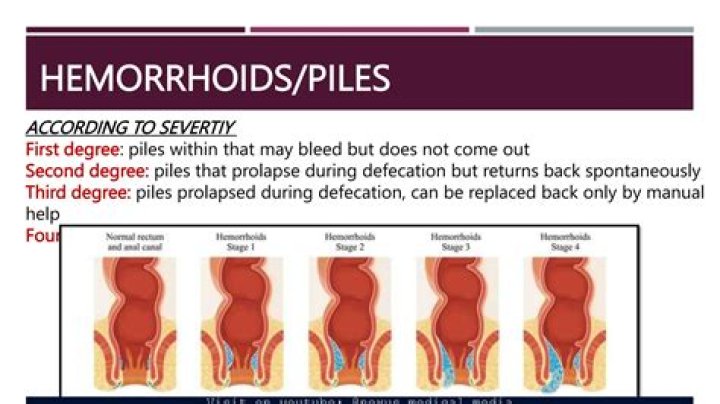 Can you bleed a lot from hemorrhoids?