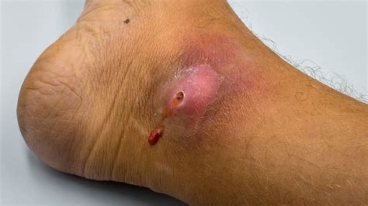 Can you put Vaseline on an infected wound?