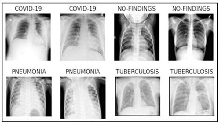 Can you survive pneumonia?