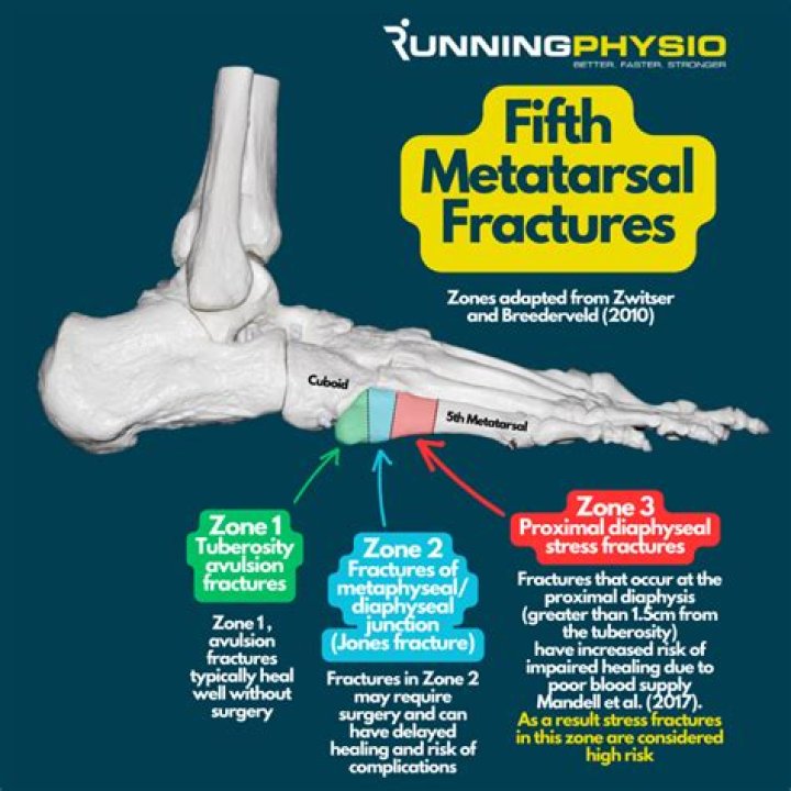 Can you walk on a fractured 5th metatarsal?