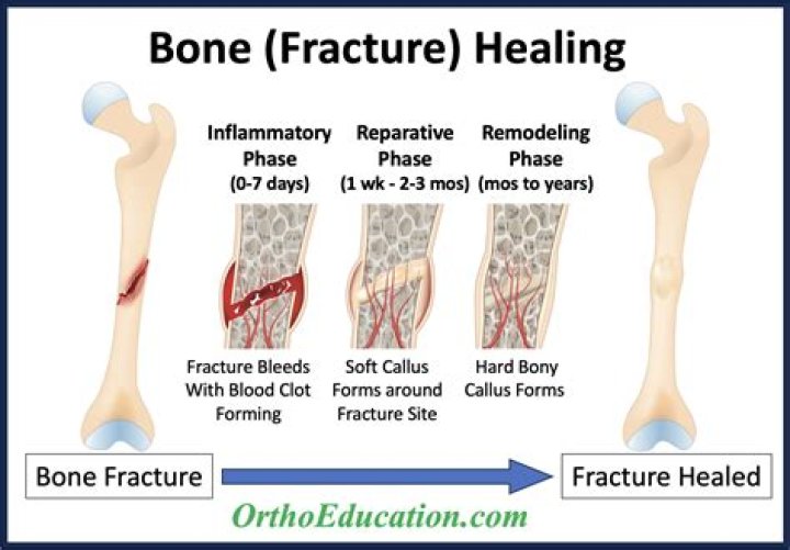 Do bones hurt when they heal?