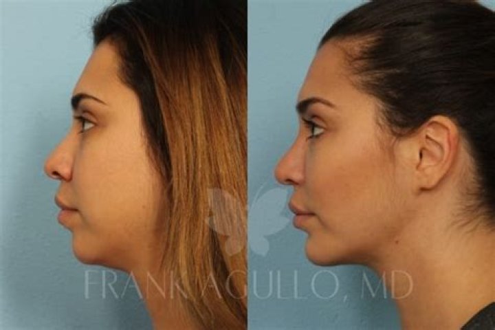 Do chubby cheeks go away?