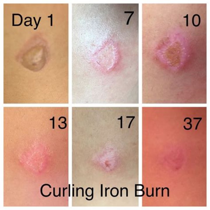 Do curling iron burns scar?