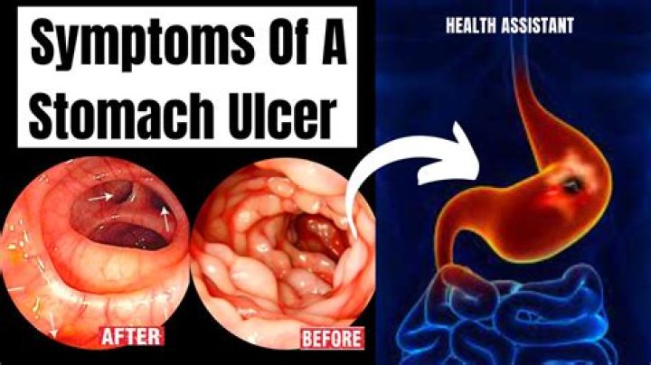 Do stomach ulcers go away?