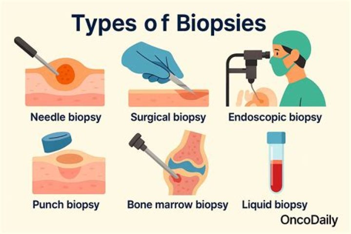 Do they only do a biopsy if they suspect cancer?