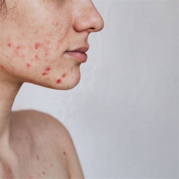Do walnuts acne?