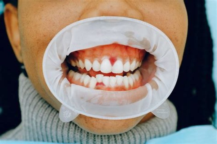 Does a throbbing tooth mean infection?