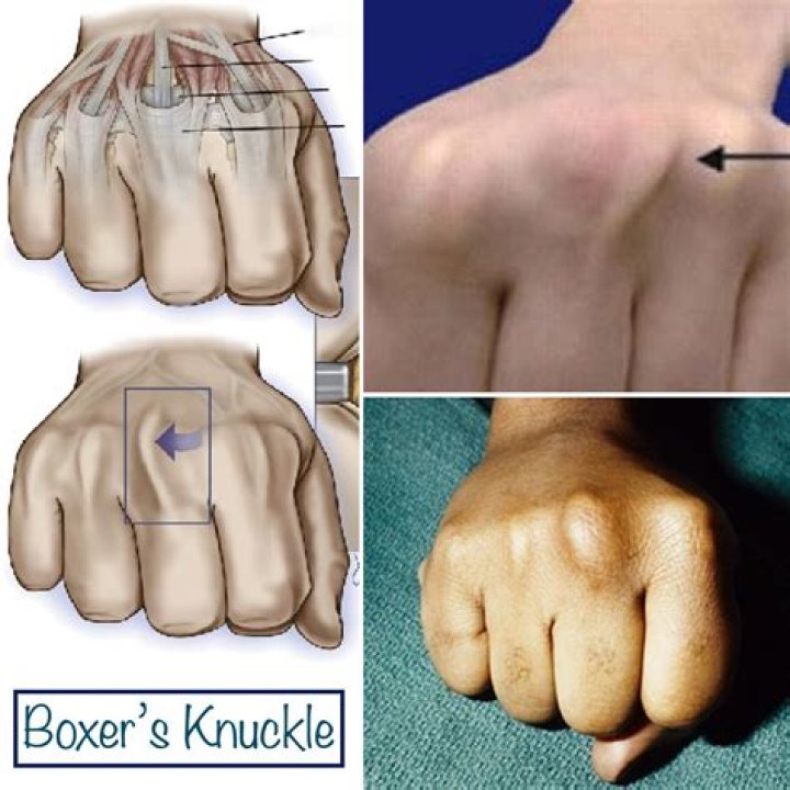 Does bare-knuckle hurt more than boxing gloves?