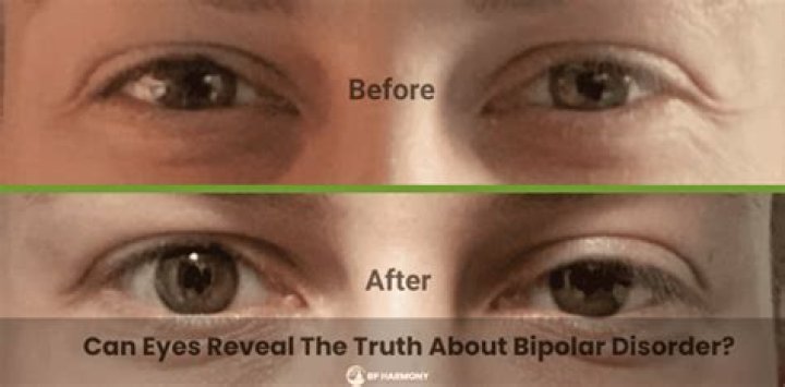 Does bipolar look like narcissism?
