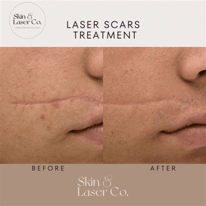 Does body contouring leave scars?