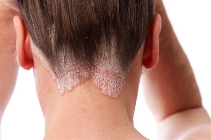 Does burnt hair grow back?