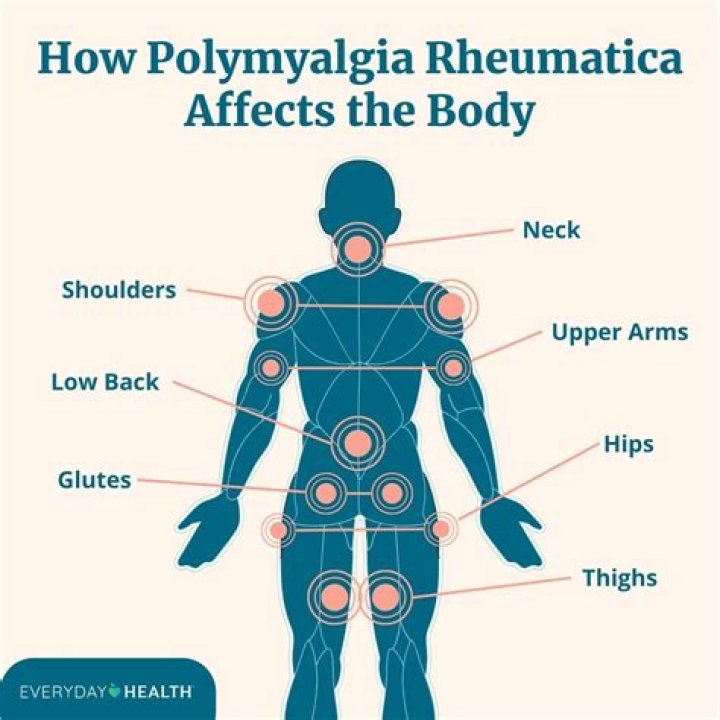 Does polymyalgia burn itself out?
