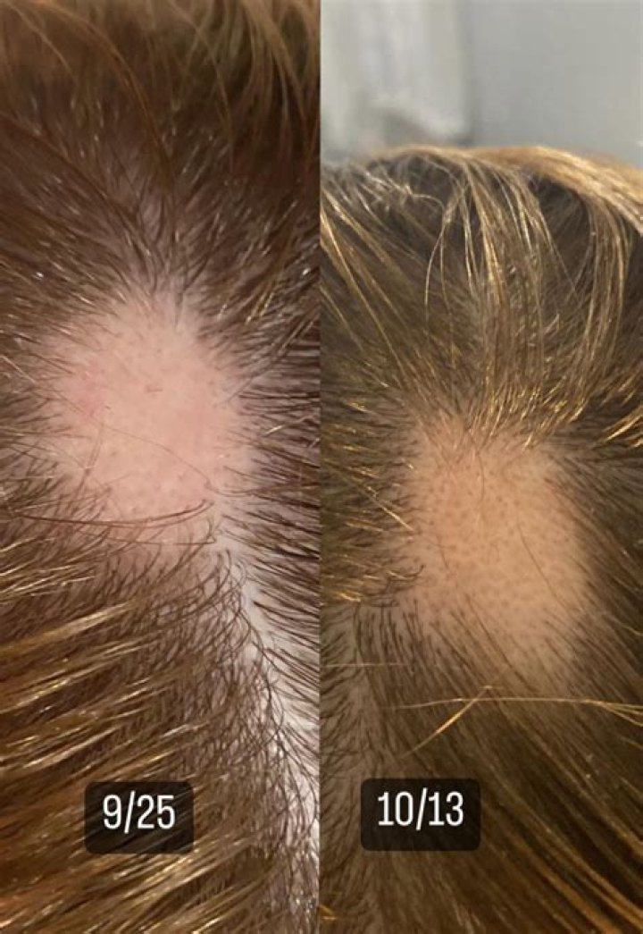 Does sugar kill hair follicles?
