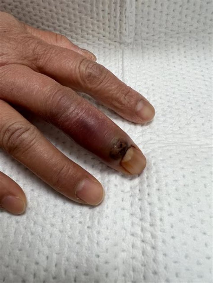 Does white finger go away?