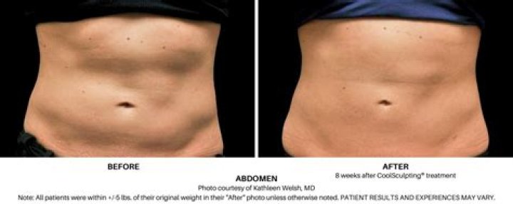 Does your poop change after CoolSculpting?