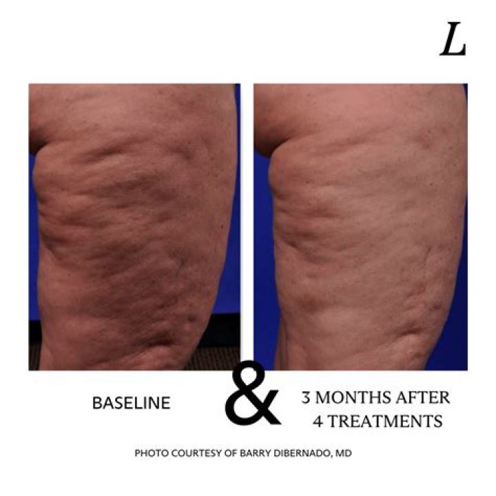 How can I minimize cellulite?