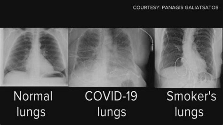 How do you clear your lungs after Covid pneumonia?
