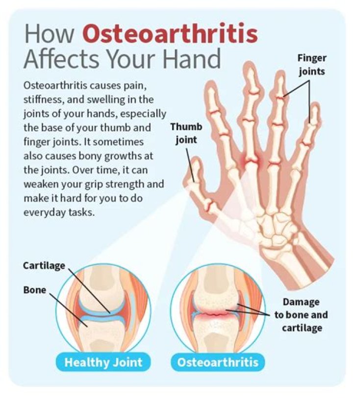 How do you know what stage of osteoarthritis you have?