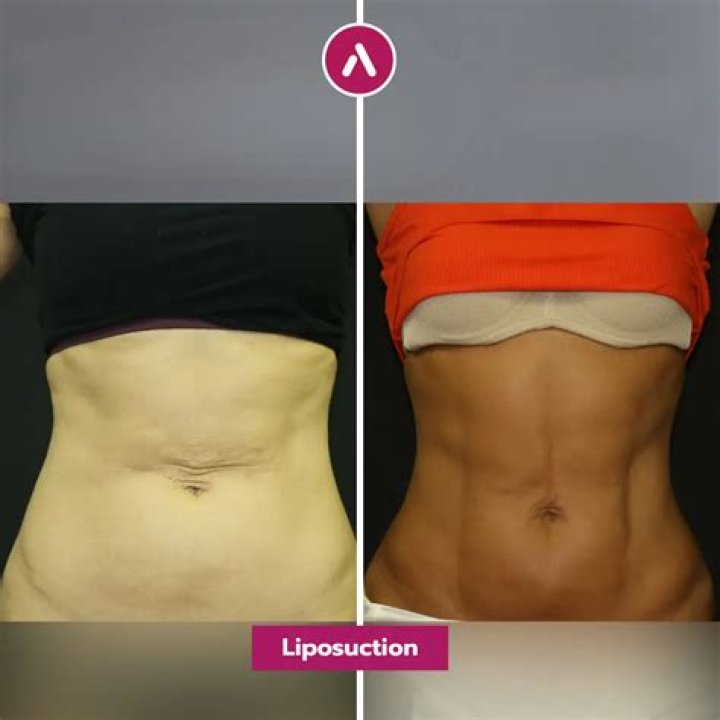 How long after lipo does it stop hurting?