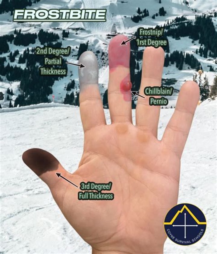How long do chilblains on fingers last?