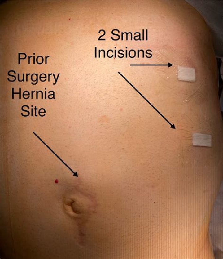 How long does it take for an incision to close?