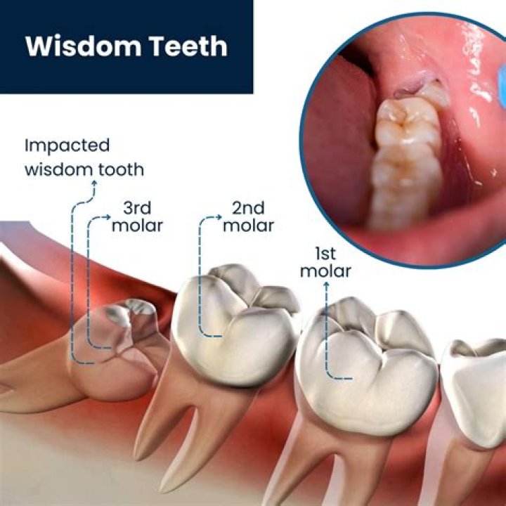 How many teeth will a dentist pull at one time?