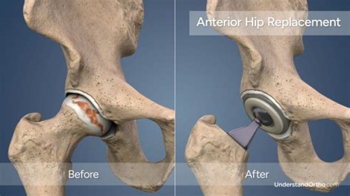 How painful is a hip replacement?