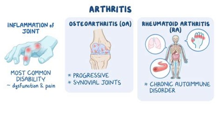 How would you describe arthritis pain?