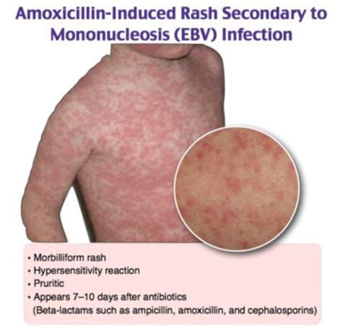 Is 5 days of amoxicillin enough for chest infection?