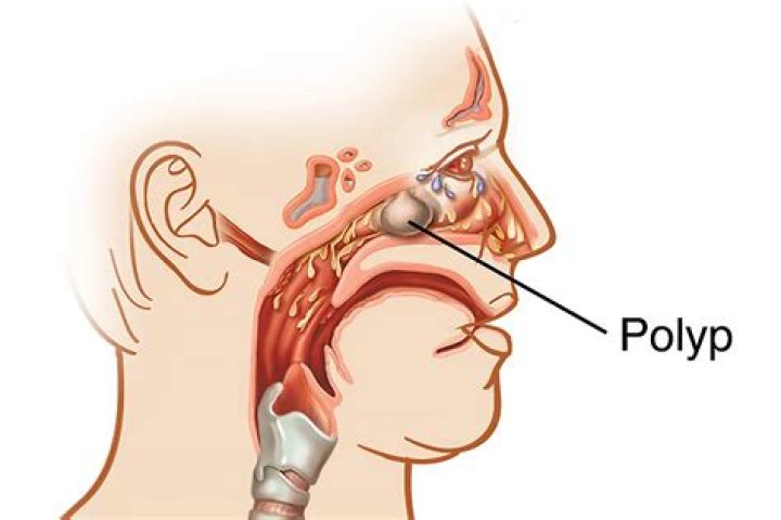 Is a 10 mm polyp big?