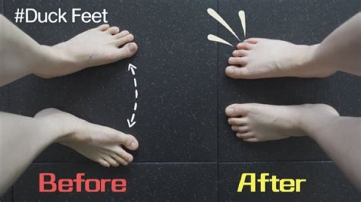 Is duck feet a disability?