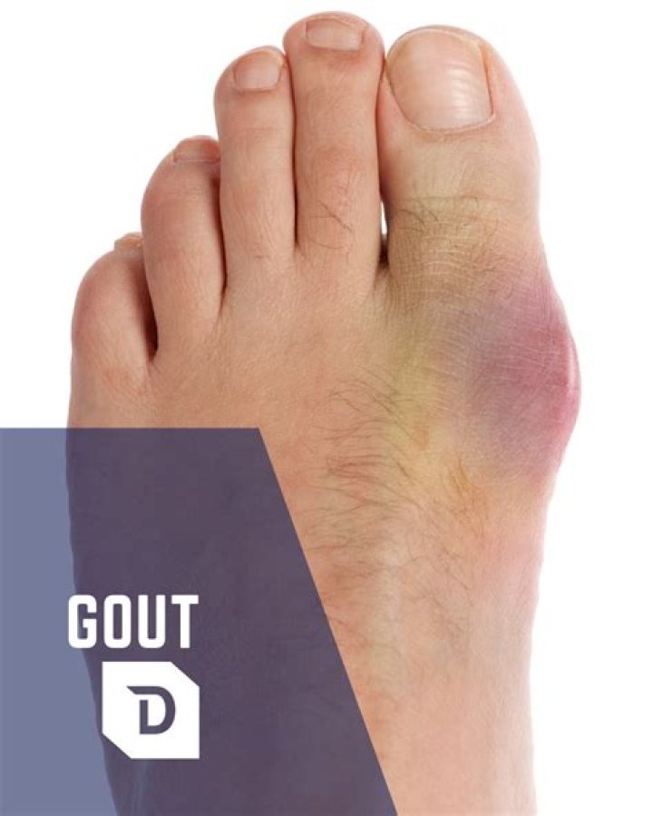 Is gout just in the foot?