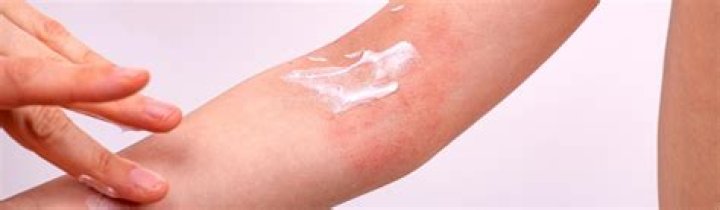 Is zinc oxide good for eczema?