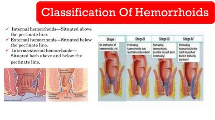 Should I go to the ER for a thrombosed hemorrhoid?