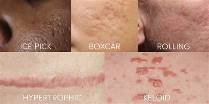 What's inside of a keloid?