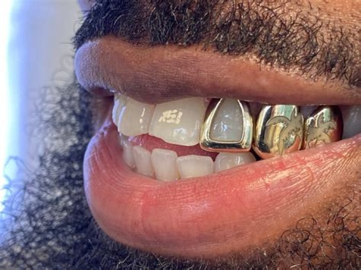What are gold teeth?