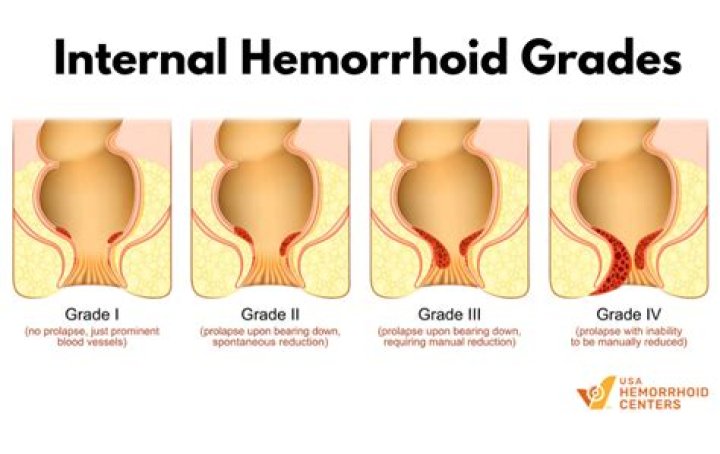 What are Stage 3 hemorrhoids?