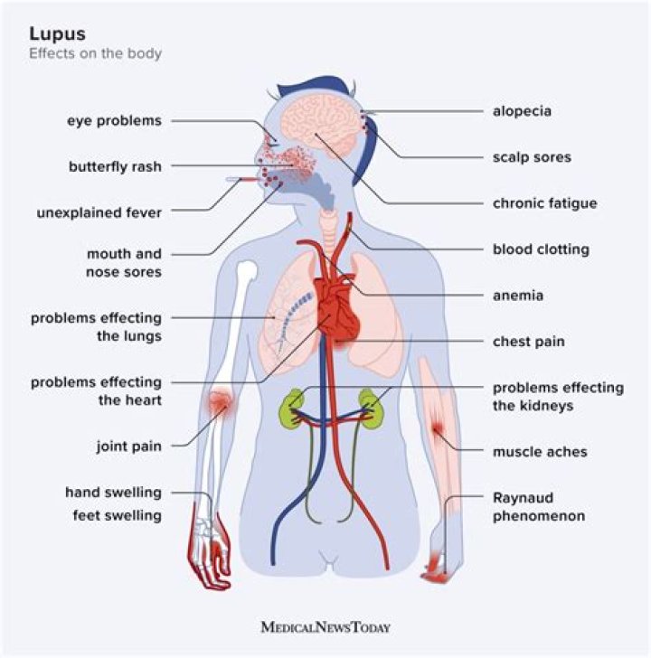 What are the 11 signs of lupus?