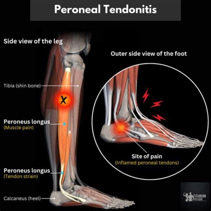 What causes tendonitis all over body?