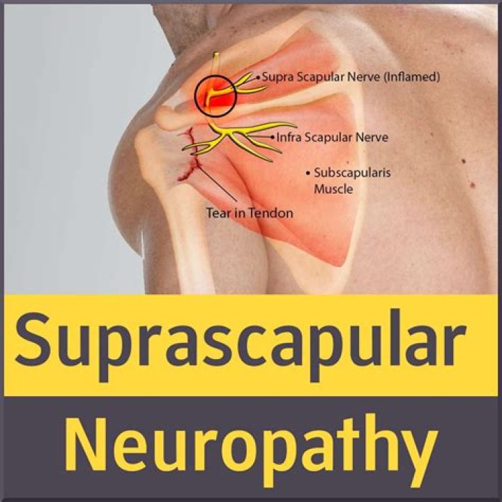 What does suprascapular nerve pain feel like?